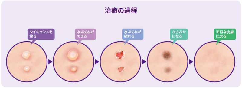 ワイキャンス塗布後の治癒の過程：塗る→水ぶくれができる→水ぶくれが破れる→かさぶたになる→正常な皮膚に戻る、の5ステップ